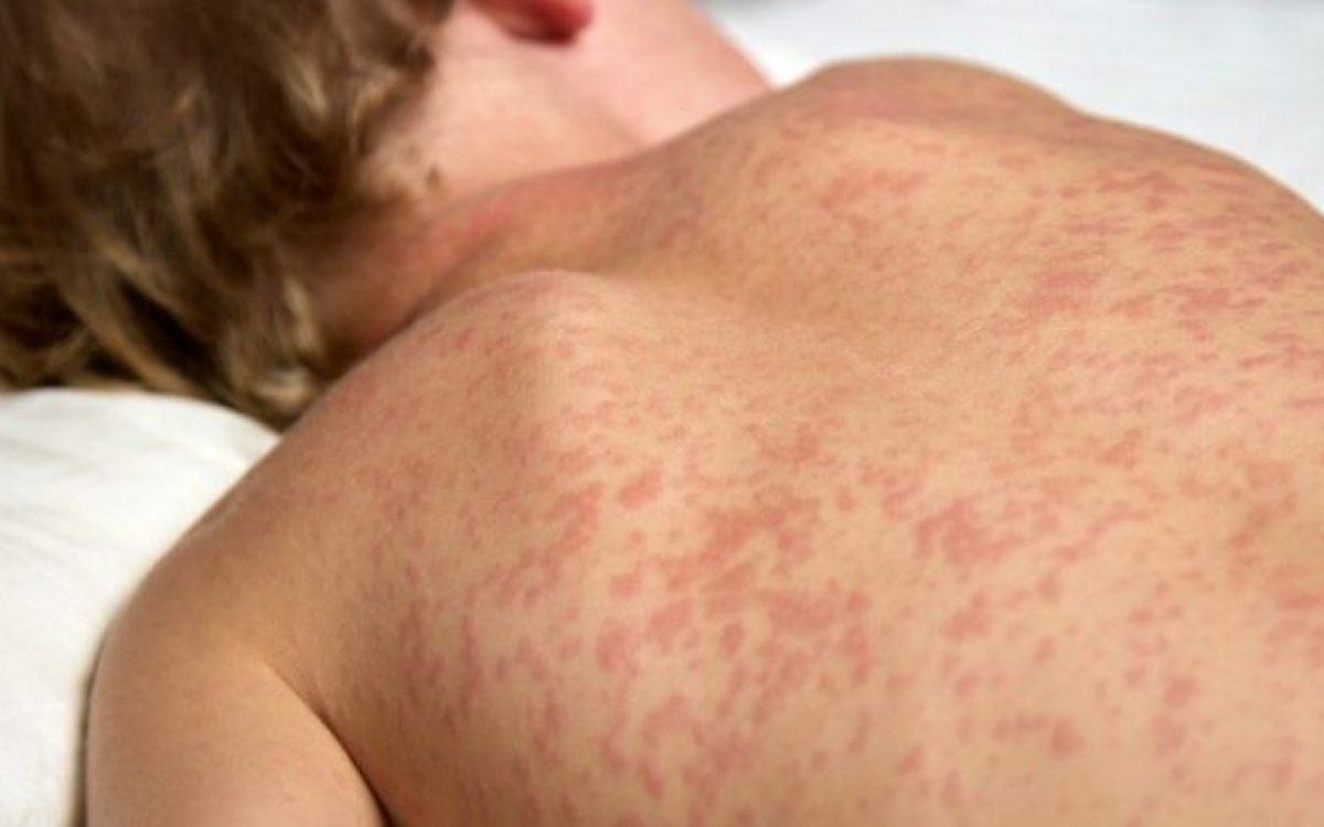 Governo qualifica profissionais de saúde e intensifica vacinação para barrar avanço do sarampo em MS